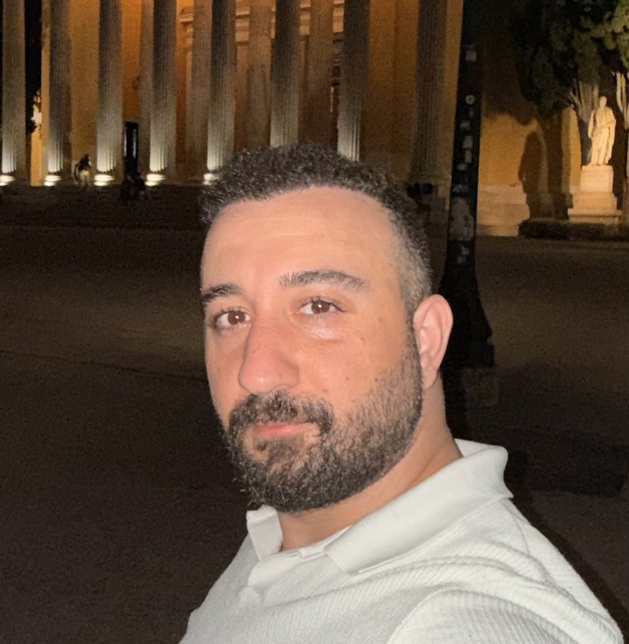 Dorukcan after his hair transplant