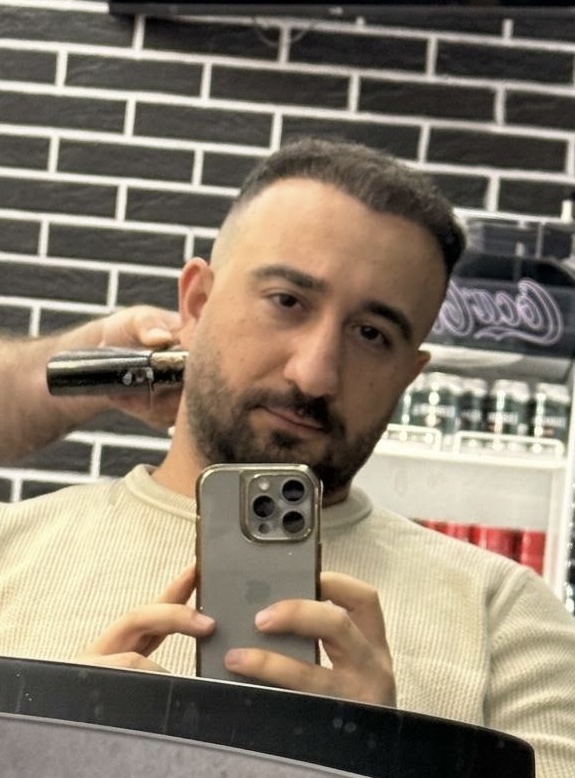 Dorukcan after his hair transplant