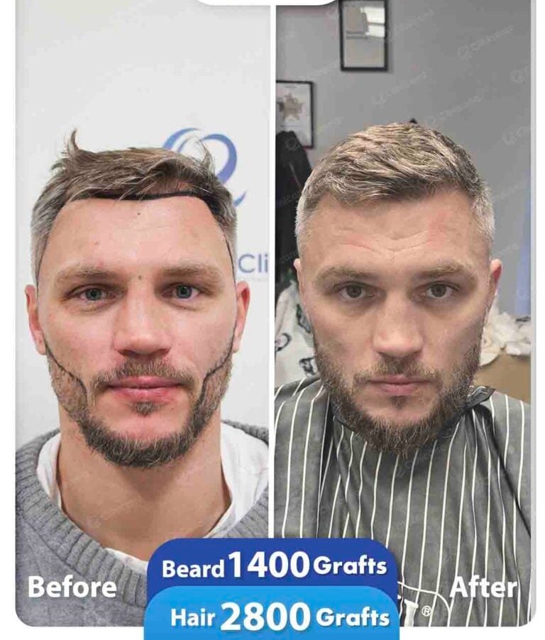 Hair and beard transplant before and after result