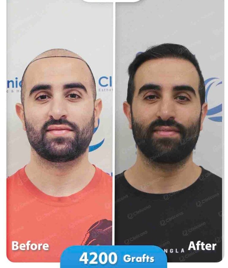 Hair transplant before and after result
