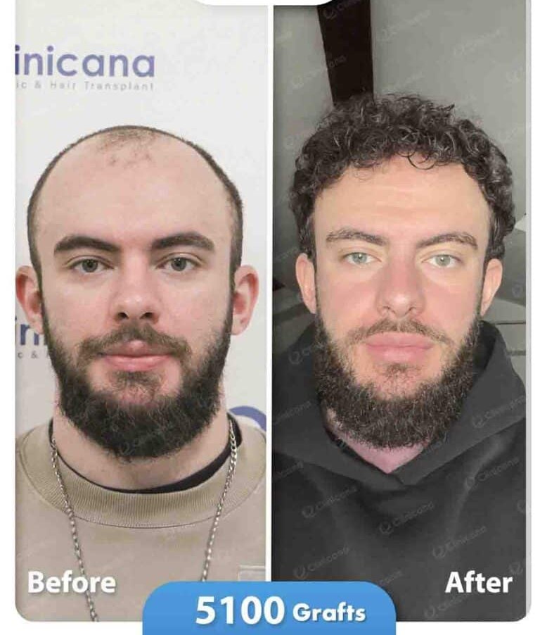 Hair transplant before and after result