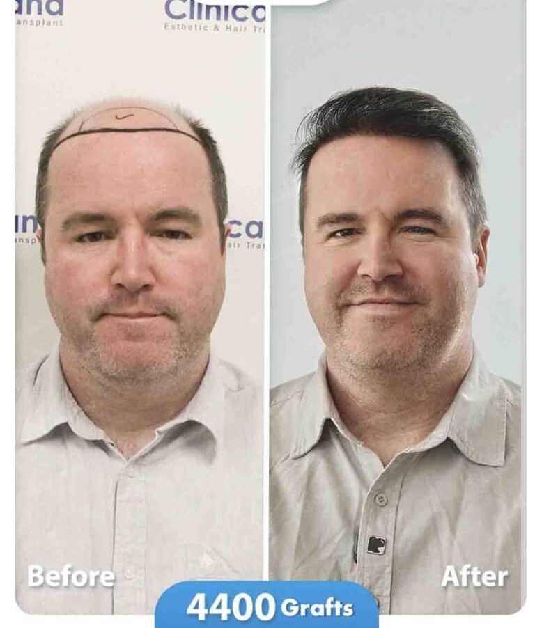 Hair transplant before and after result