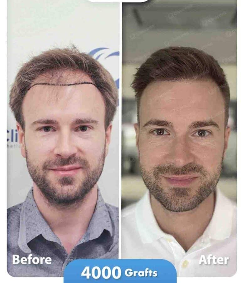 Hair transplant before and after result