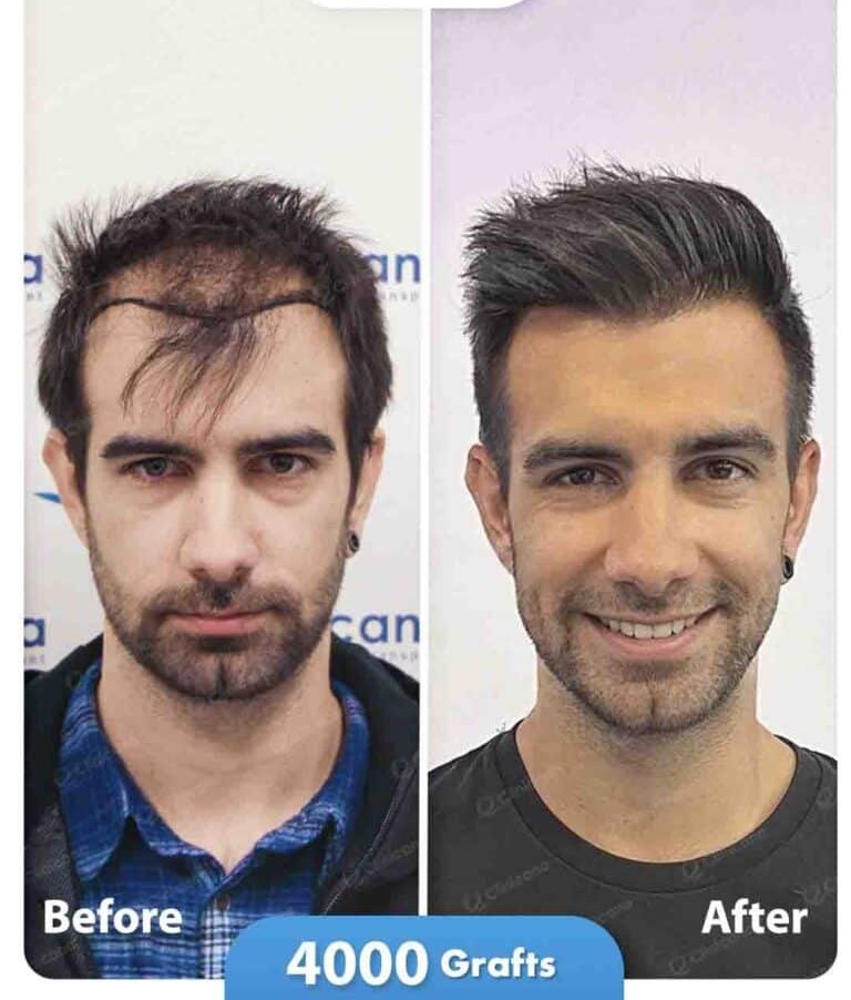 Hair transplant before and after result