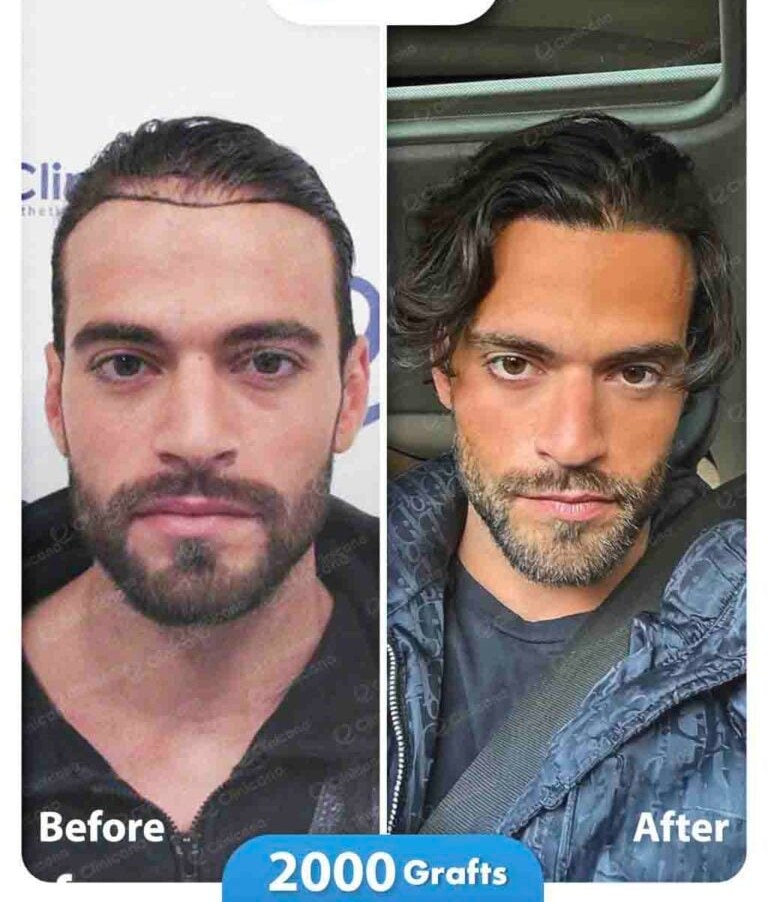 Hair transplant before and after result