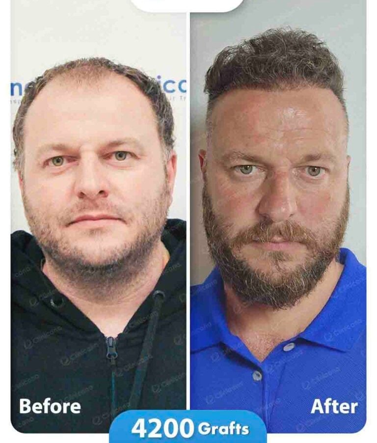 Hair transplant before and after result